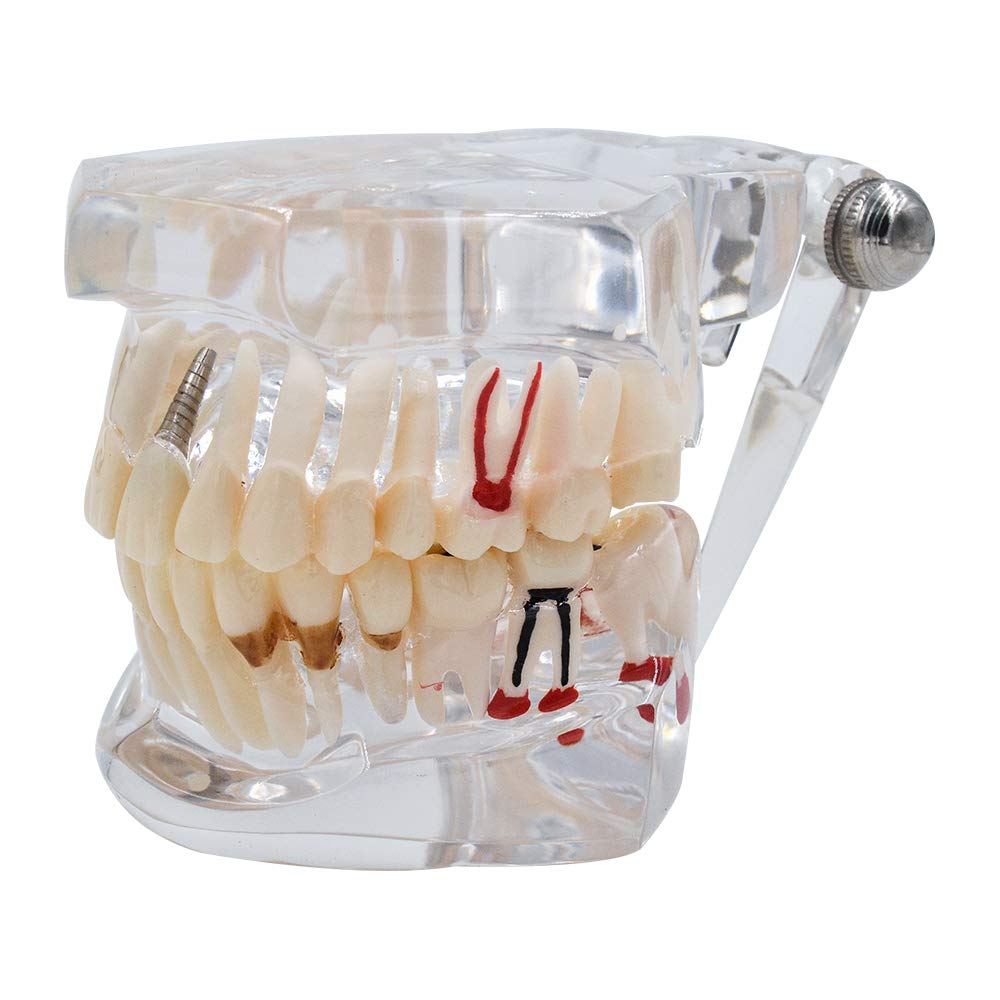 Dental All In One Implant Study Model | Transparent White