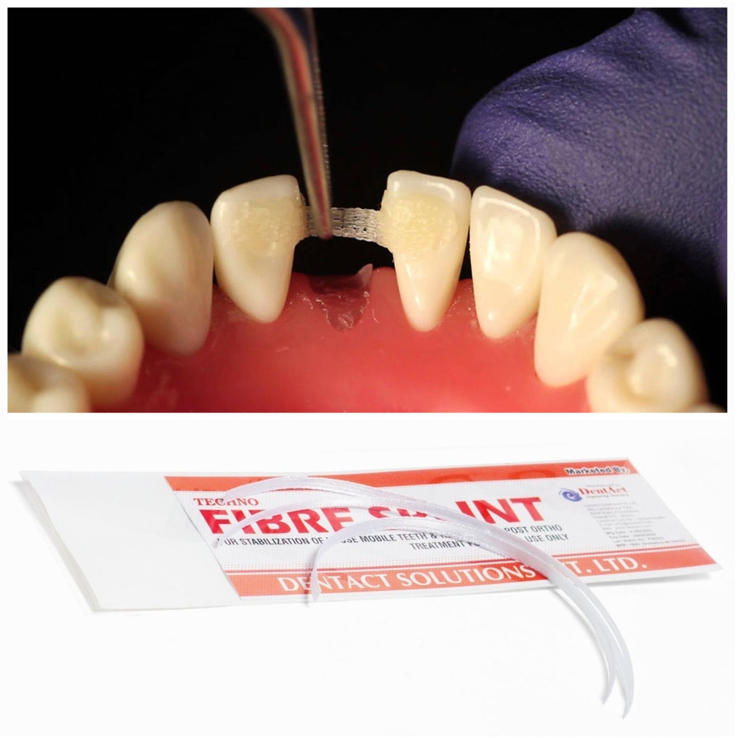 Dental Fiber Splint | Glass Fiber Resin for quick Prosthesis and Periodontal Splinting