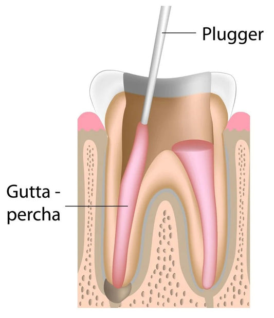 GDC Root Canal Plugger Luks .50mm .75mm 3 - RCP5/7