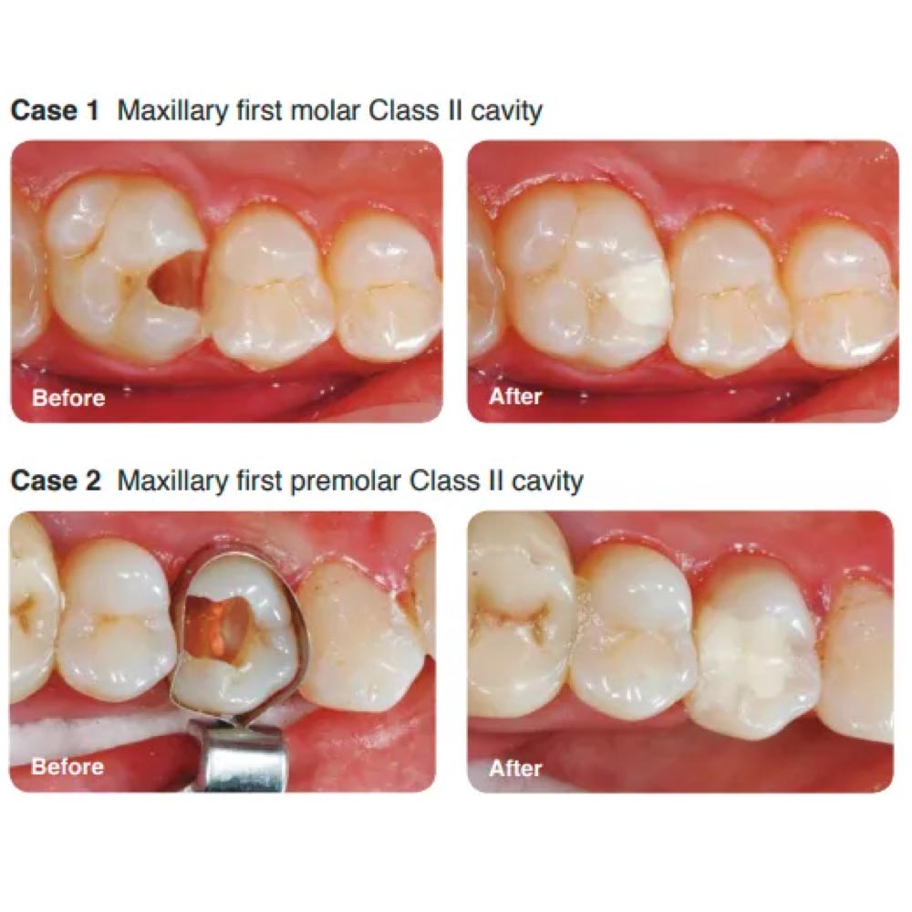 SHOFU Zirconomer Improved | Zirconia-Reinforced Glass Ionomer Restorative