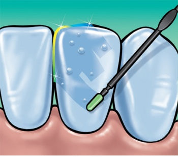 IVOCLAR Fluor Protector Dental Varnish