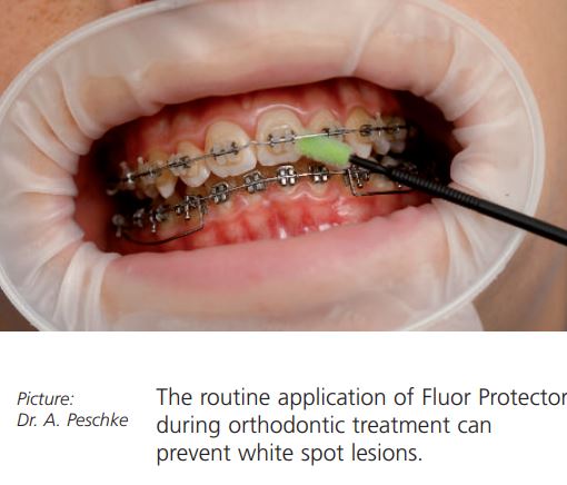 IVOCLAR Fluor Protector Dental Varnish