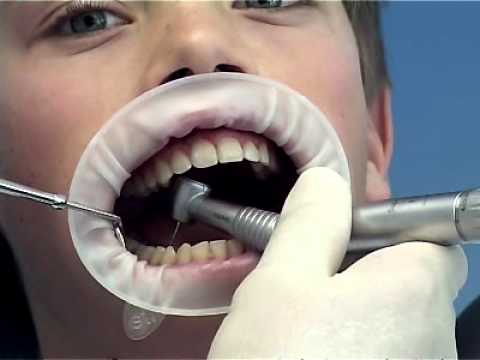 IVOCLAR Optragate (Pack Of 5)