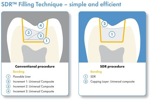 DENTSPLY SDR Flowable Bulk Filling Material