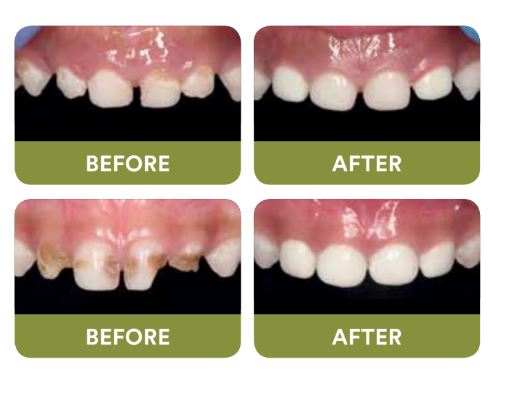 3M Paedodontic Zirconia Crowns Kits