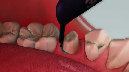 3M ESPE Astringent Retraction Paste Capsule | Gingival Retraction Material