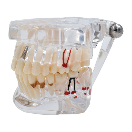 Dental All In One Implant Study Model | Transparent White