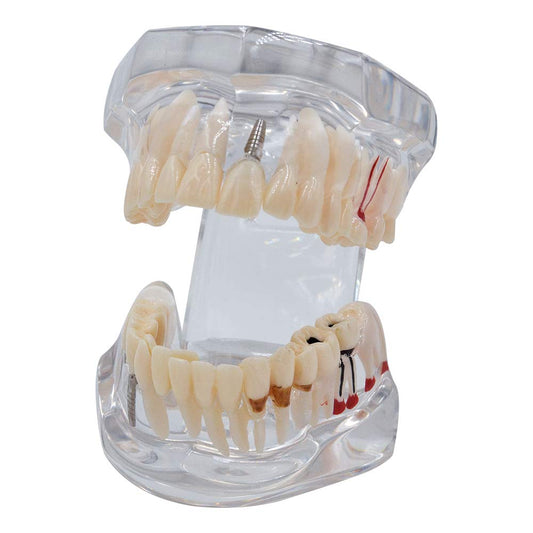 Dental All In One Implant Study Model | Transparent White