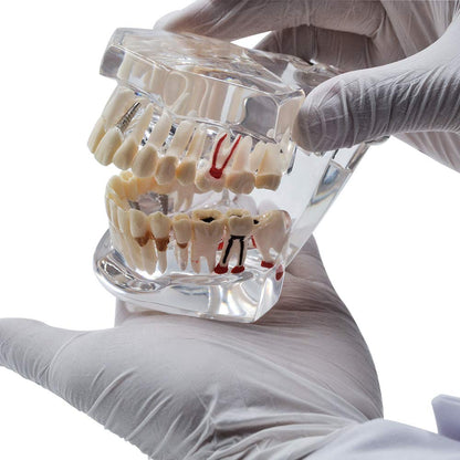 Dental All In One Implant Study Model | Transparent White