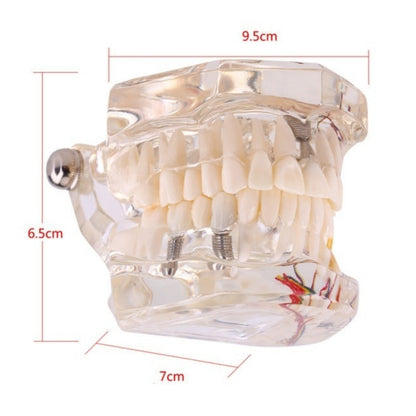 Dental All In One Implant Study Model | Transparent White