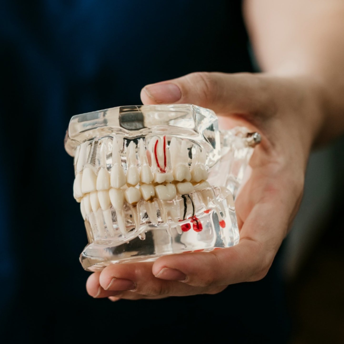 Dental All In One Implant Study Model | Transparent White