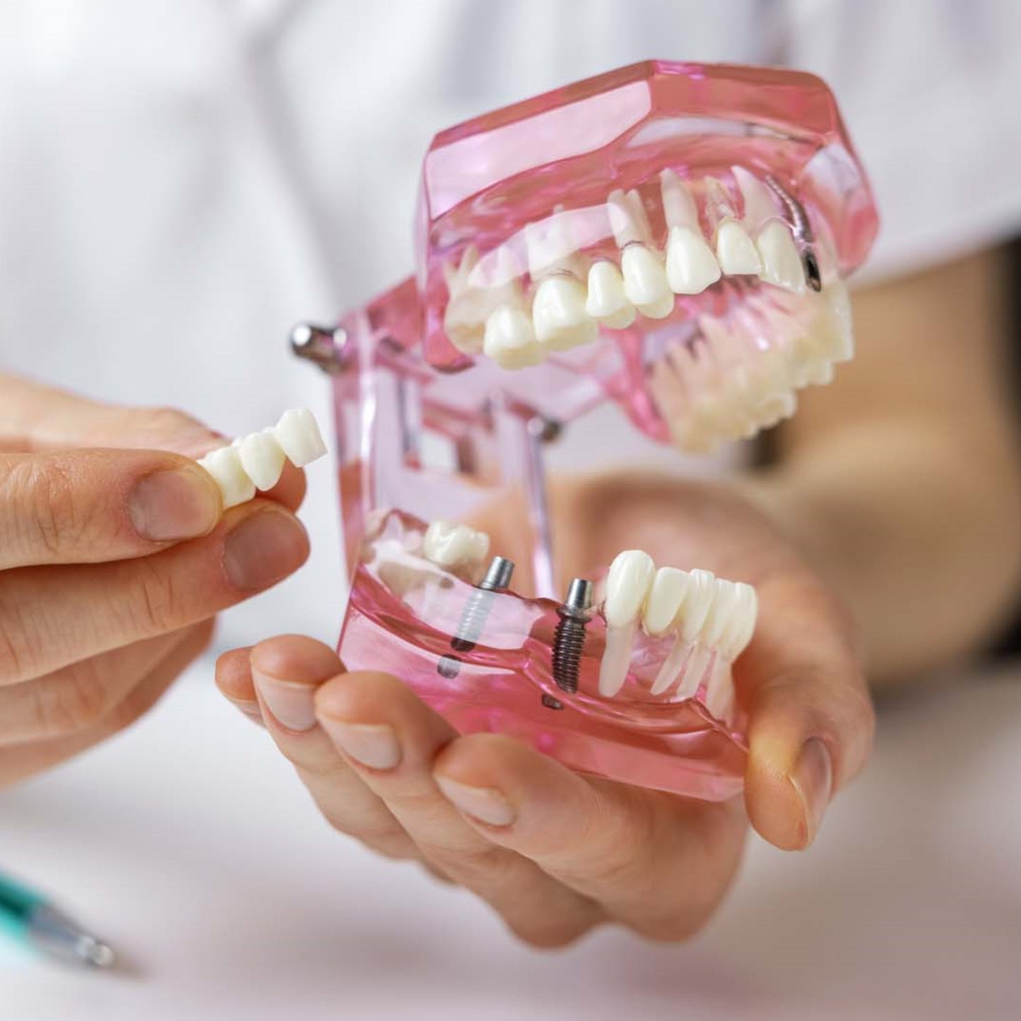 Dental All In One Implant Study Model | Transparent White