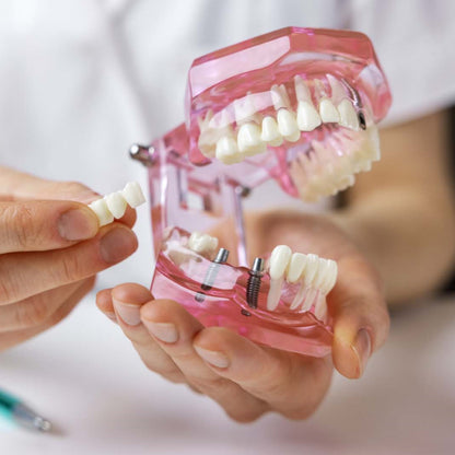 Dental All In One Implant Study Model | Transparent White
