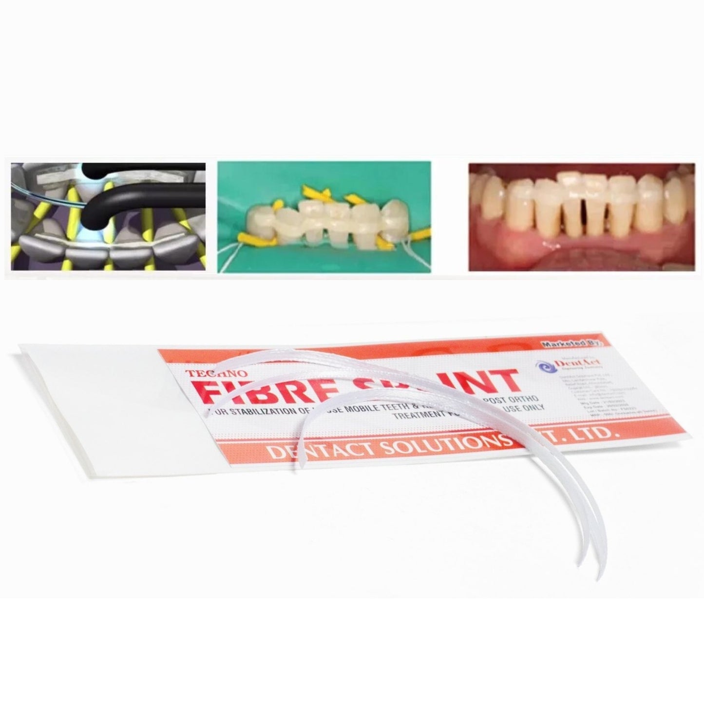 Dental Fiber Splint | Glass Fiber Resin for quick Prosthesis and Periodontal Splinting
