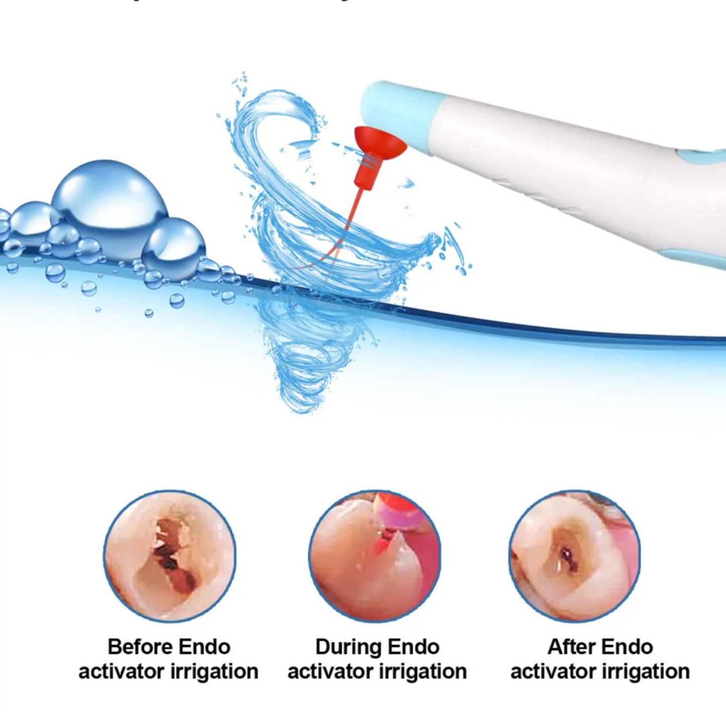 Dental Sonic Endo Irrigator With 120 Tips | Endodontic Irrigator