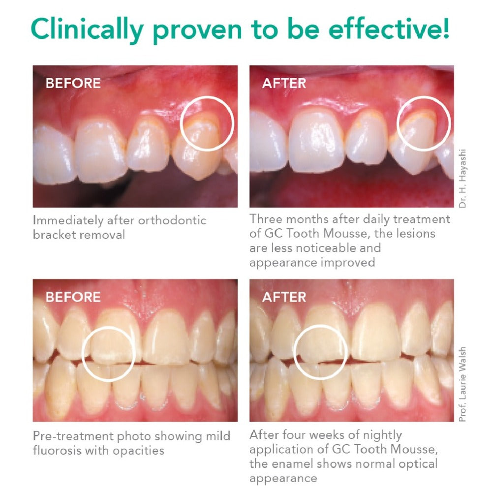 GC Tooth Mousse | Topical Dental Creme | Remineralising SUGAR-FREE Dental Topical Paste, Containing Bio-Available Calcium and Phosphate