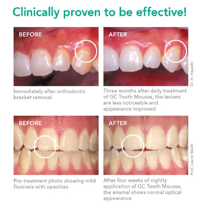 GC Tooth Mousse | Topical Dental Creme | Remineralising SUGAR-FREE Dental Topical Paste, Containing Bio-Available Calcium and Phosphate