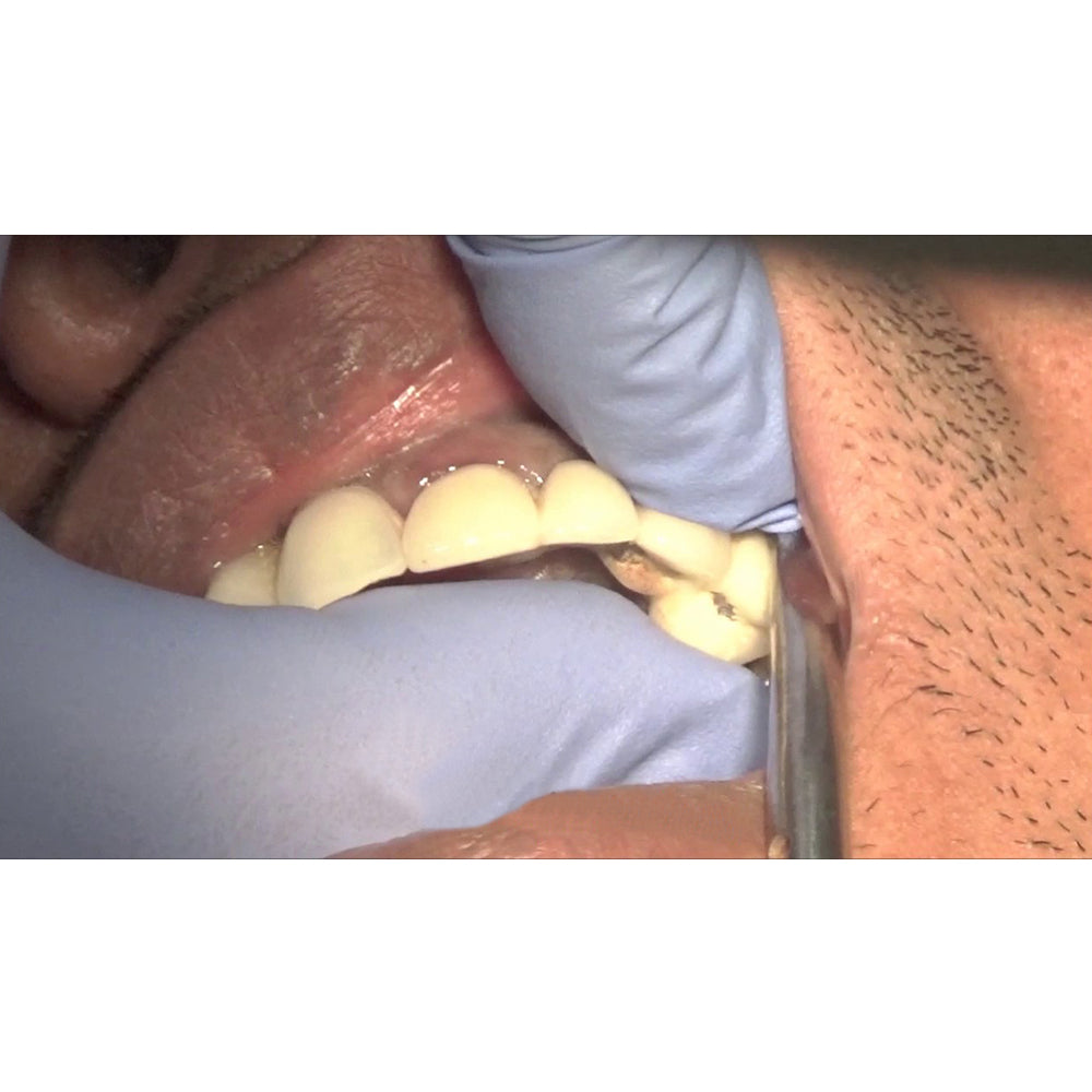 GDC Automatic Crown Remover Standard