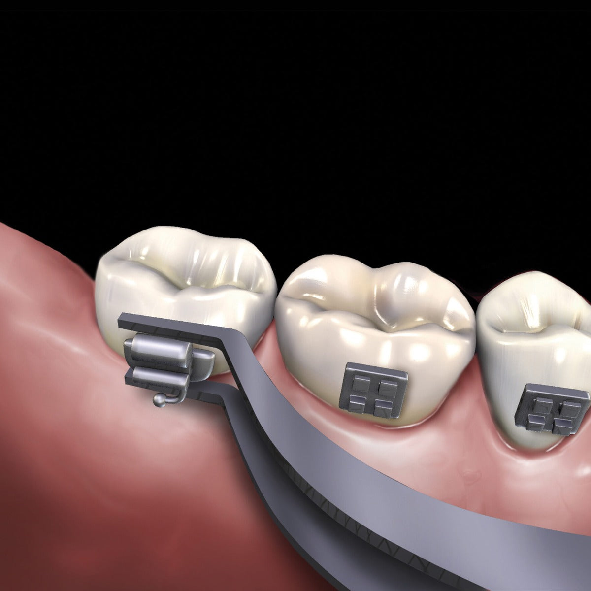 GDC Buccal Tube Holder - 1134