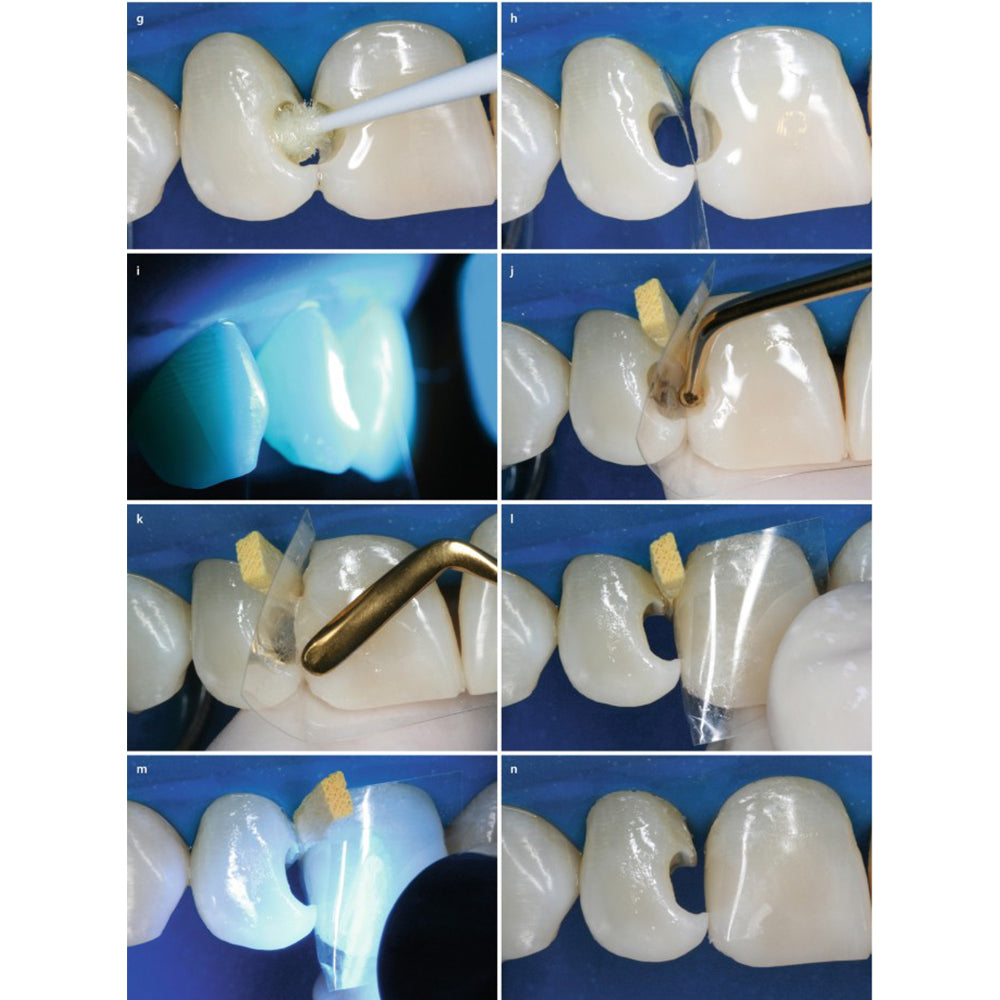 GDC Composite Instrument Gold Titanium 6 - CIG2
