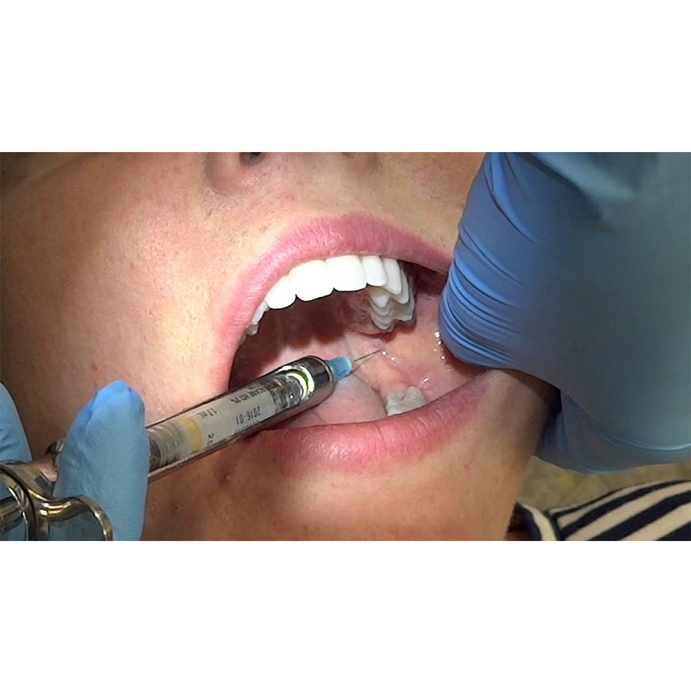 GDC Dental Syringe Aspirating With Ring 1.8ml - SYRA1.8