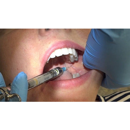 GDC Dental Syringe Aspirating With Ring 1.8ml - SYRA1.8