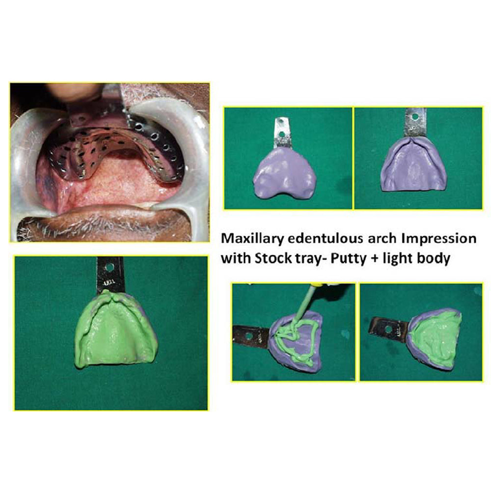 GDC Edentulous Perforated Impression Trays Upper 2 - ITRLEDPU2