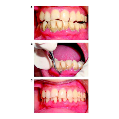GDC Manipal Scaler Set Of 3 PCS Instruments Kit