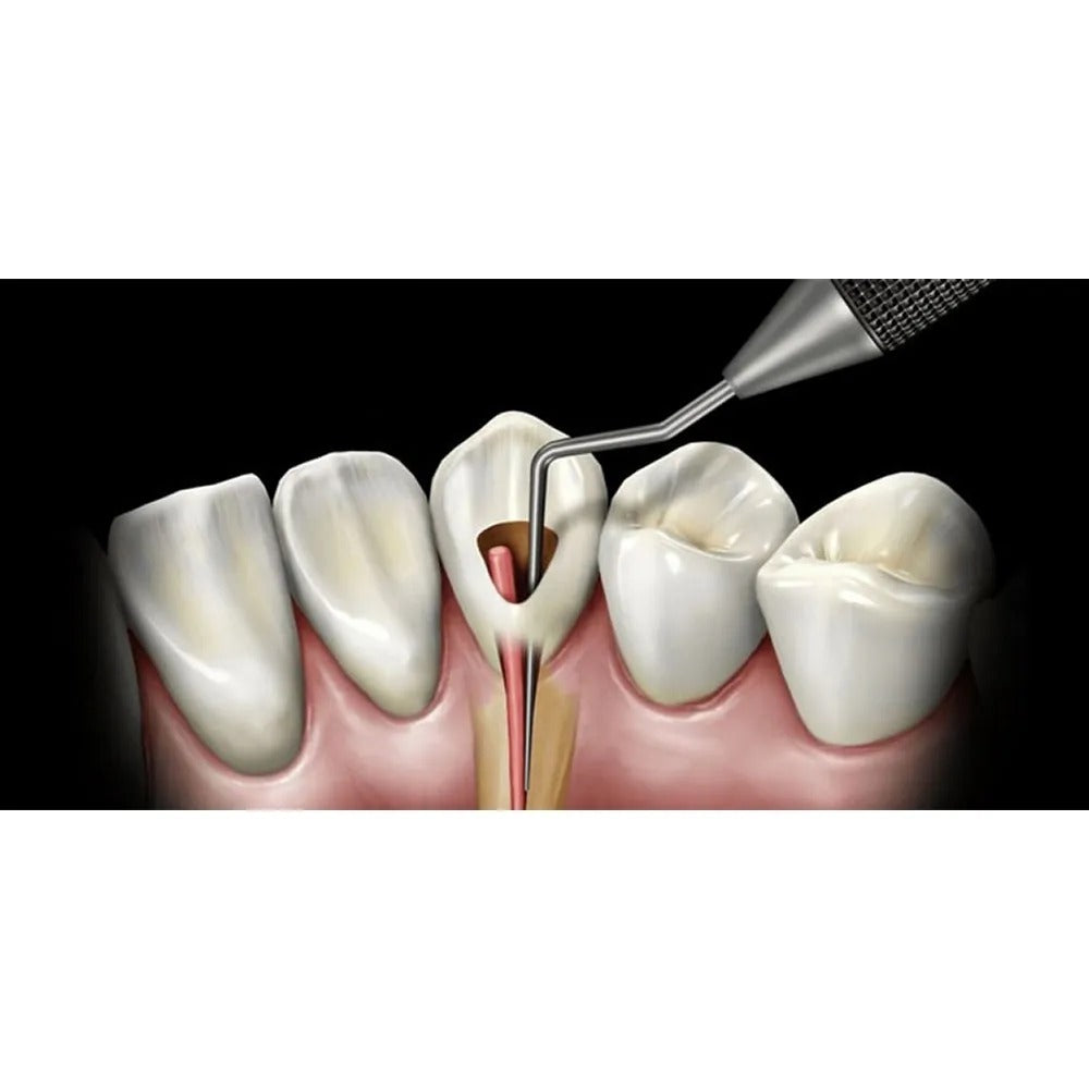 GDC Root Canal Plugger Luks .50mm .75mm 3 - RCP5/7