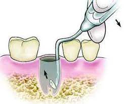 GDC Root Elevators Root Tip Pick Heidbrink - Left - EHB2