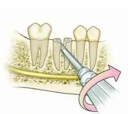 GDC Root Elevators Root Tip Pick Heidbrink - Straight - EHB1