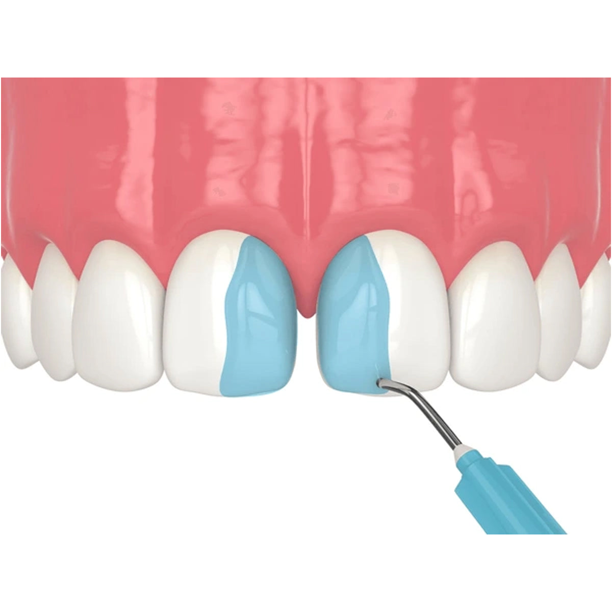IVOCLAR N Etchant Gel | Etchant Gel