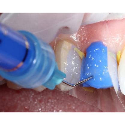 IVOCLAR N Etchant Gel | Etchant Gel