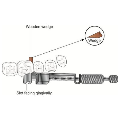 JENIN Tofflemire Matrix Retainer | Universal Matrix System is used in Class II Restorations