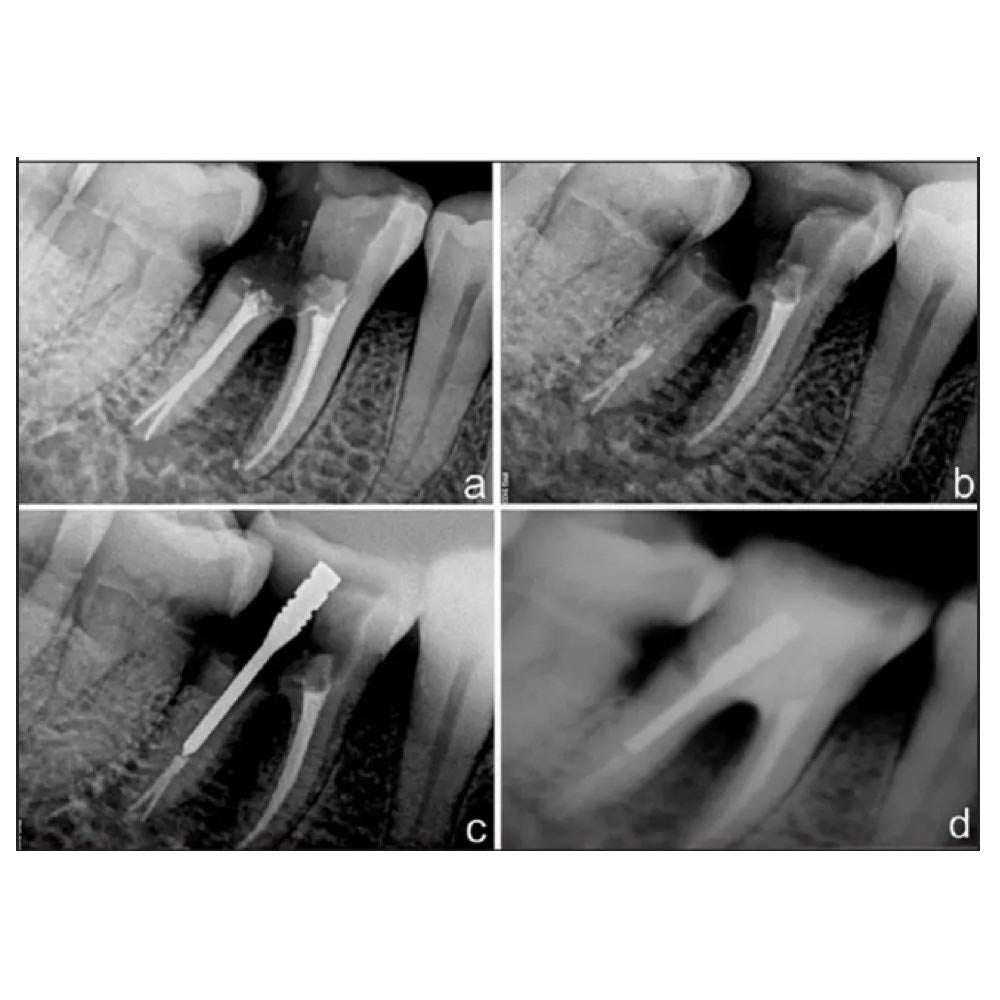 Prime Dental i Post #3P Pack of 10 Integrated Endodontic Metal Post
