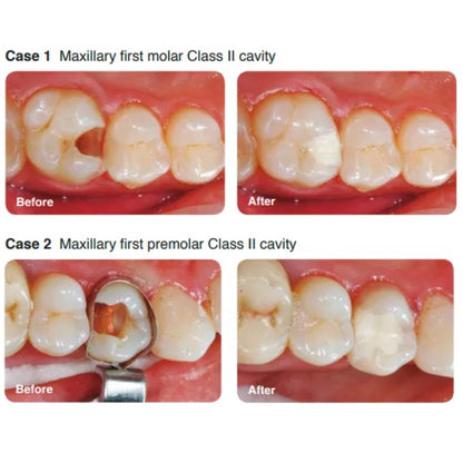SHOFU Zirconomer Improved | Zirconia-Reinforced Glass Ionomer Restorative