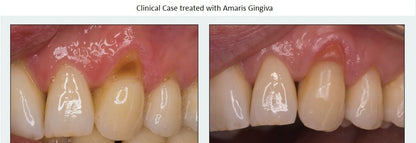 VOCO Amaris Gingiva - Set & Refill