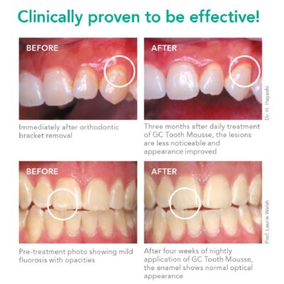 GC Tooth Mousse | Topical Dental Creme | Remineralising SUGAR-FREE Dental Topical Paste, Containing Bio-Available Calcium and Phosphate - Image 7