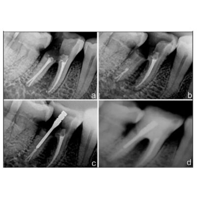 Prime Dental i Post #2P Pack of 10 Integrated Endodontic Metal Post - Image 4